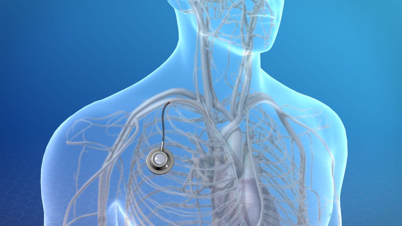 TIVAD / Port Catheter